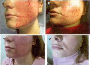 stages of skin repair after fractional removal process