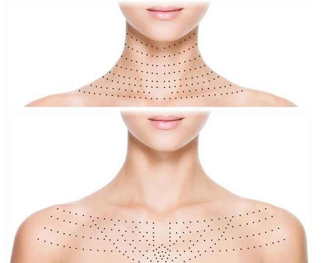 Marking on the skin of the neck and décolleté for rejuvenating bio-rejuvenation