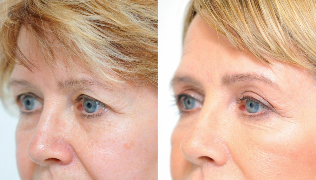 eyelid-before-and-after