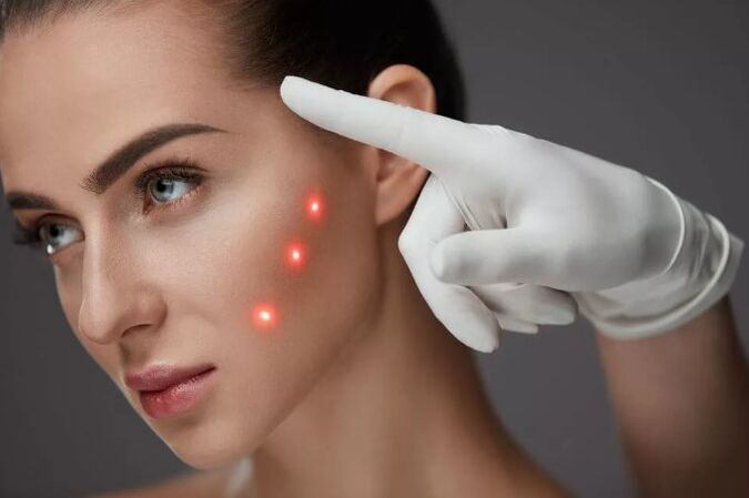 Rejuvenation with skin laser