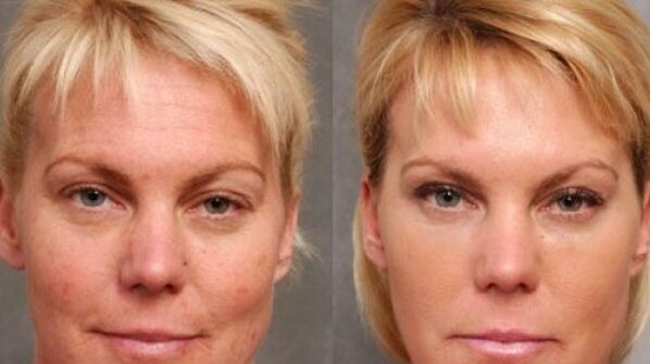 Before and after the renewal process