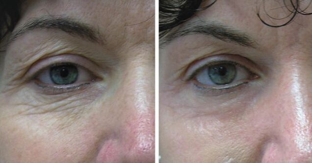 Laser leather around the eyes
