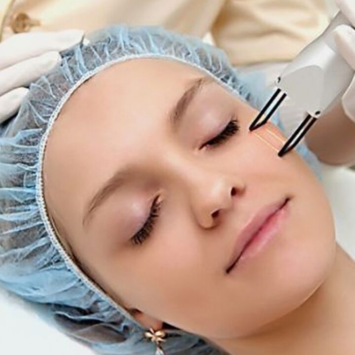Fractional rejuvenation with laser